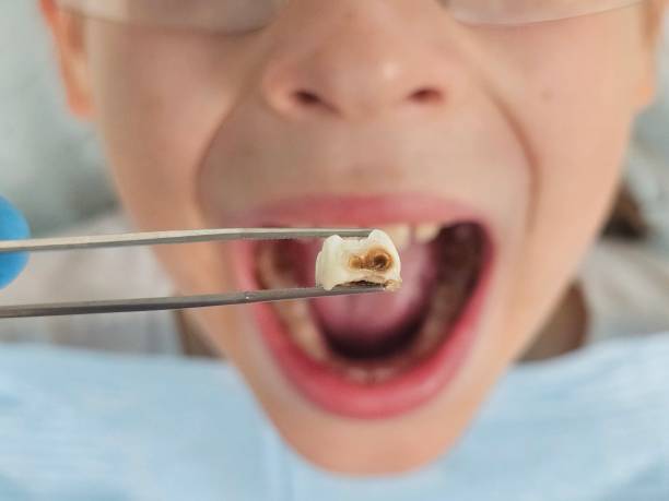 Best Urgent Tooth Repair  in Snyder, TX